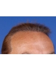 After Hair Transplant&nbsp;2 Sessions (Areas)